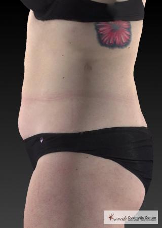 CoolSculpting®: Patient 25 - Before