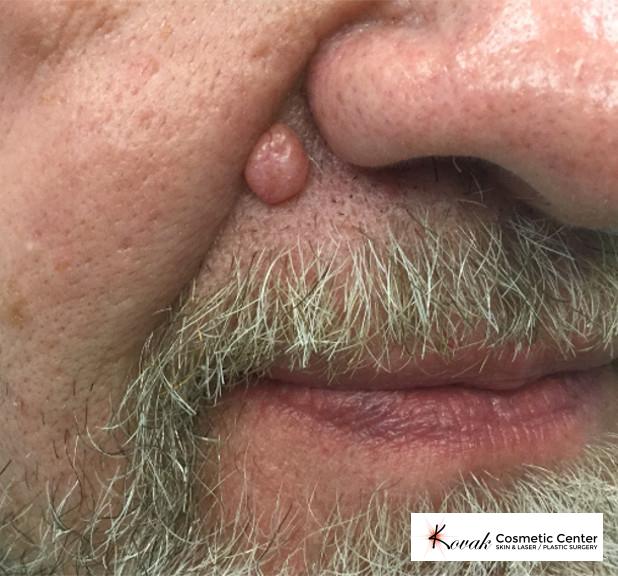 Mole Removal: Patient 2 - Before 