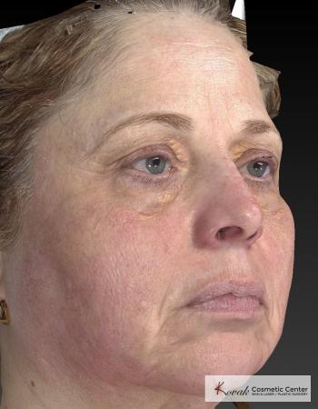 Tyte And Bryte – Face: Patient 3 - After Image 5
