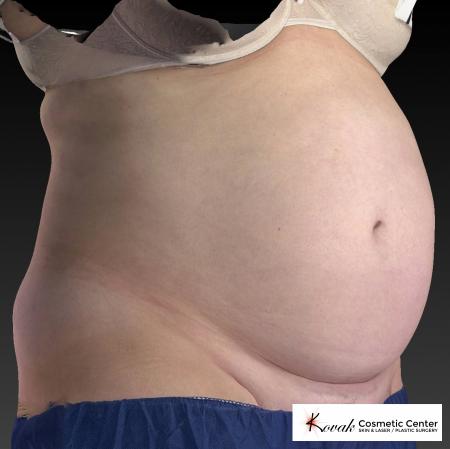 CoolSculpting®: Patient 11 - Before 4