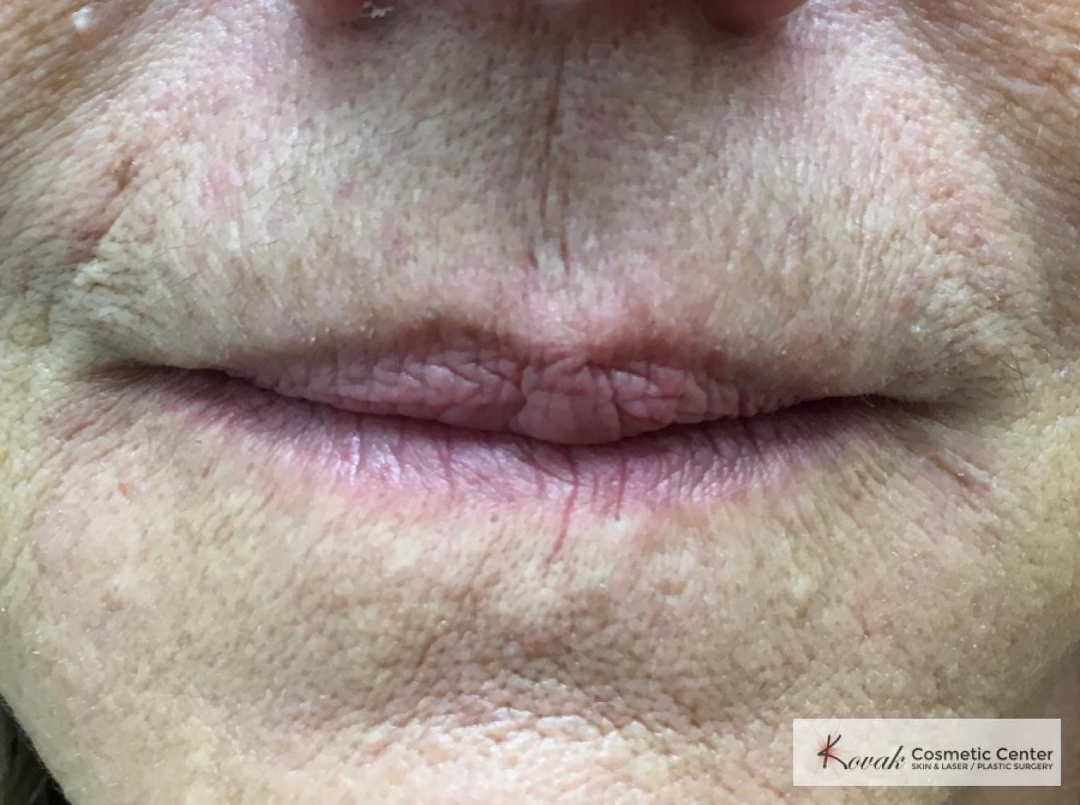 Restylane Silk for fine lines around the mouth on a 69 year old female - After  