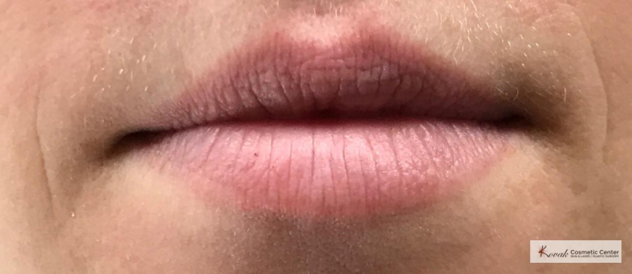 Restylane®: Patient 2 - Before and After 3