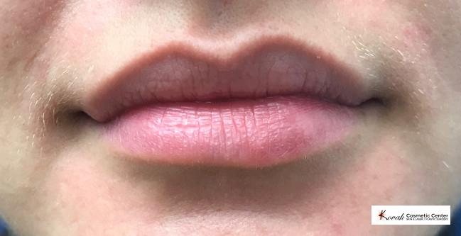 Juvéderm® XC: Patient 6 - Before 