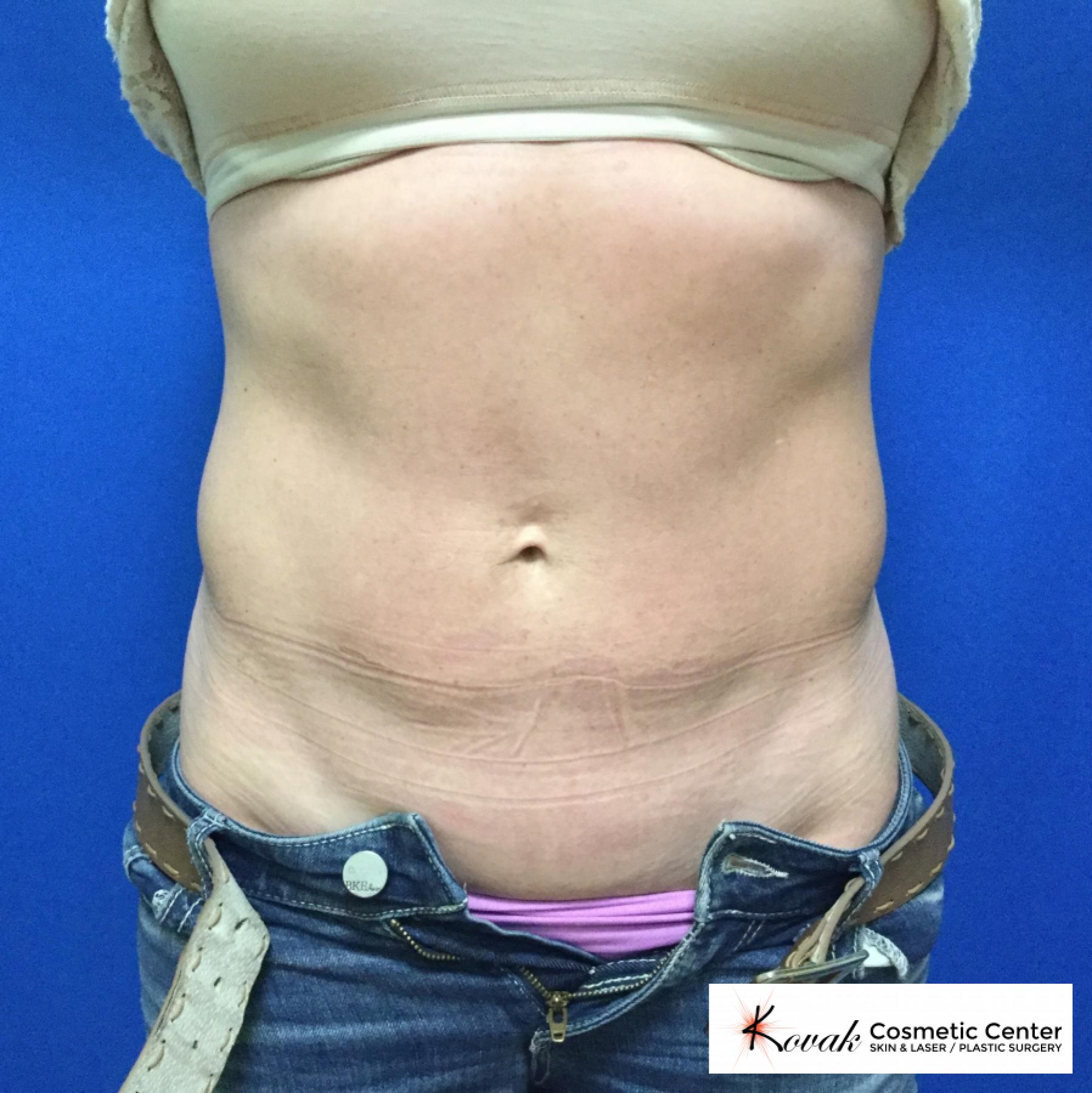 CoolSculpting®: Patient 2 - After  