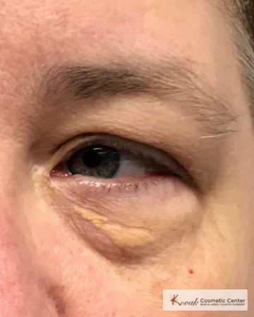 Lumps & Bumps: Patient 4 - Before Image 1