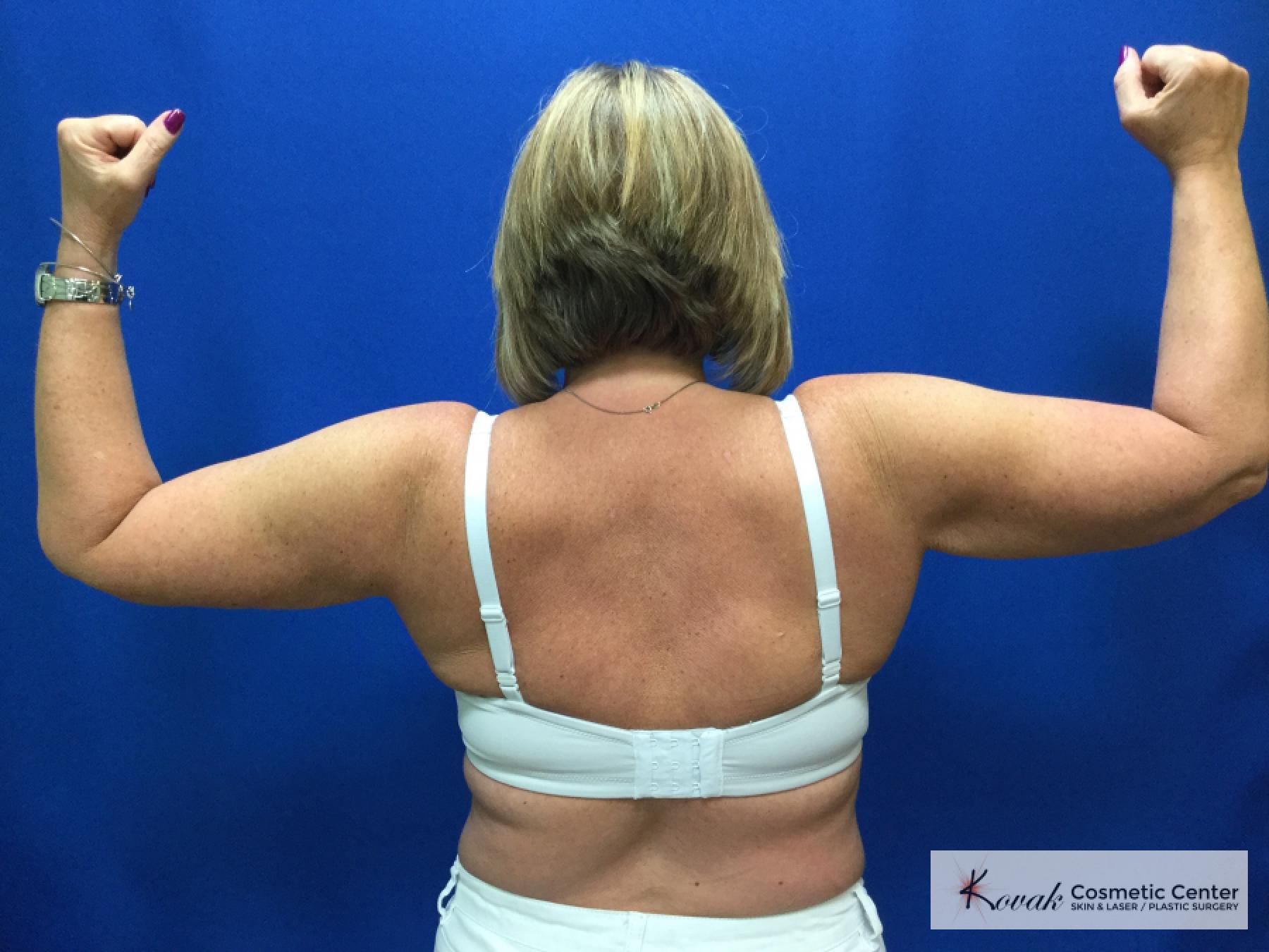 Laser Liposuction of the arms on a 42 year old woman - After  