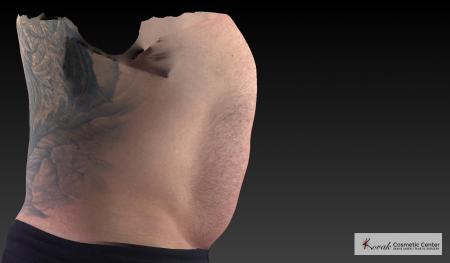 CoolSculpting®: Patient 20 - Before 1