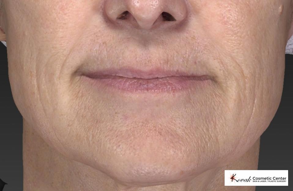 Restylane® Silk: Patient 2 - After  