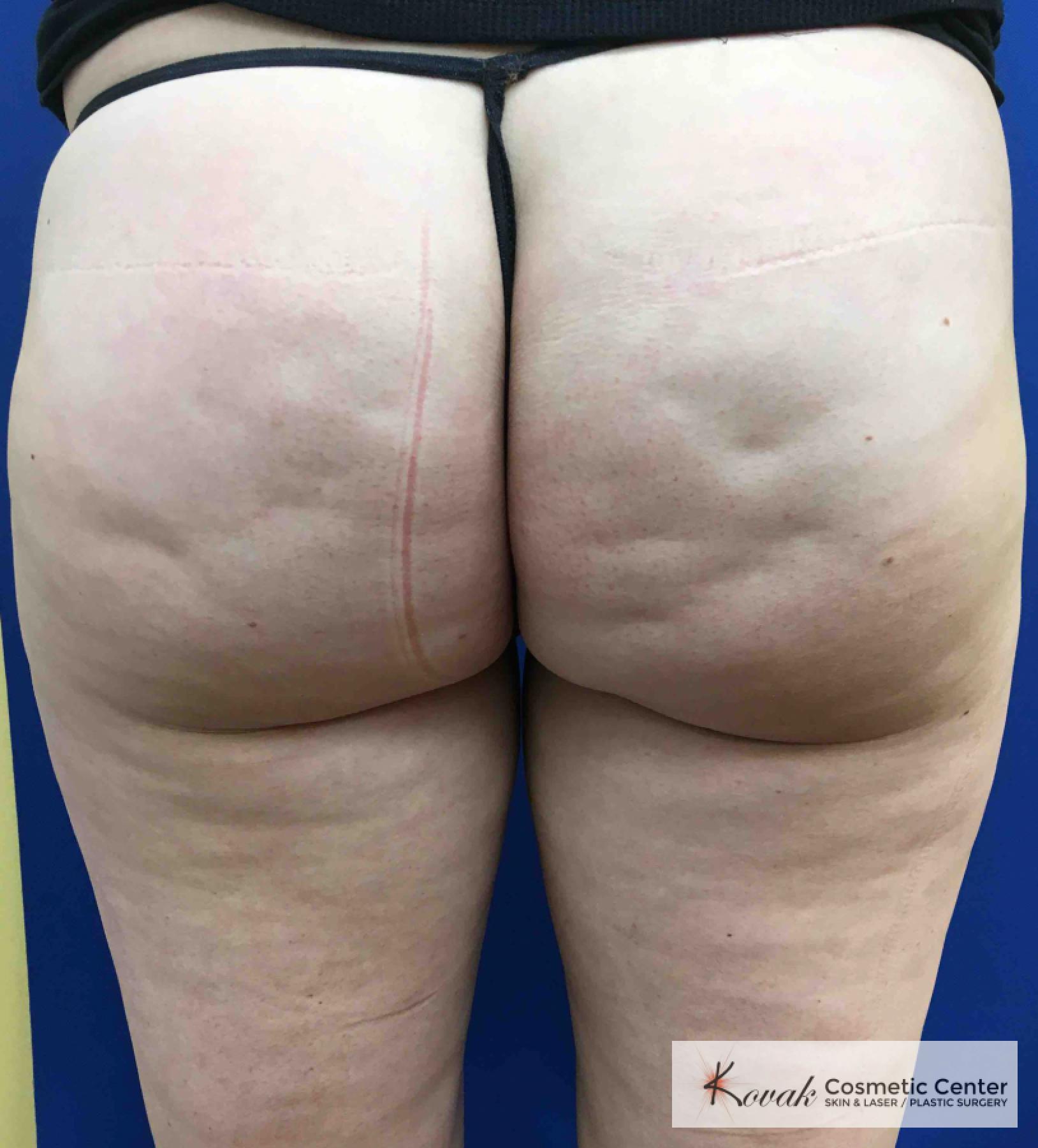 Cellulite Reduction: Patient 3 - Before 
