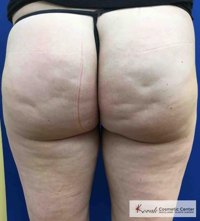 Cellulite Reduction: Patient 3 - Before Image 1