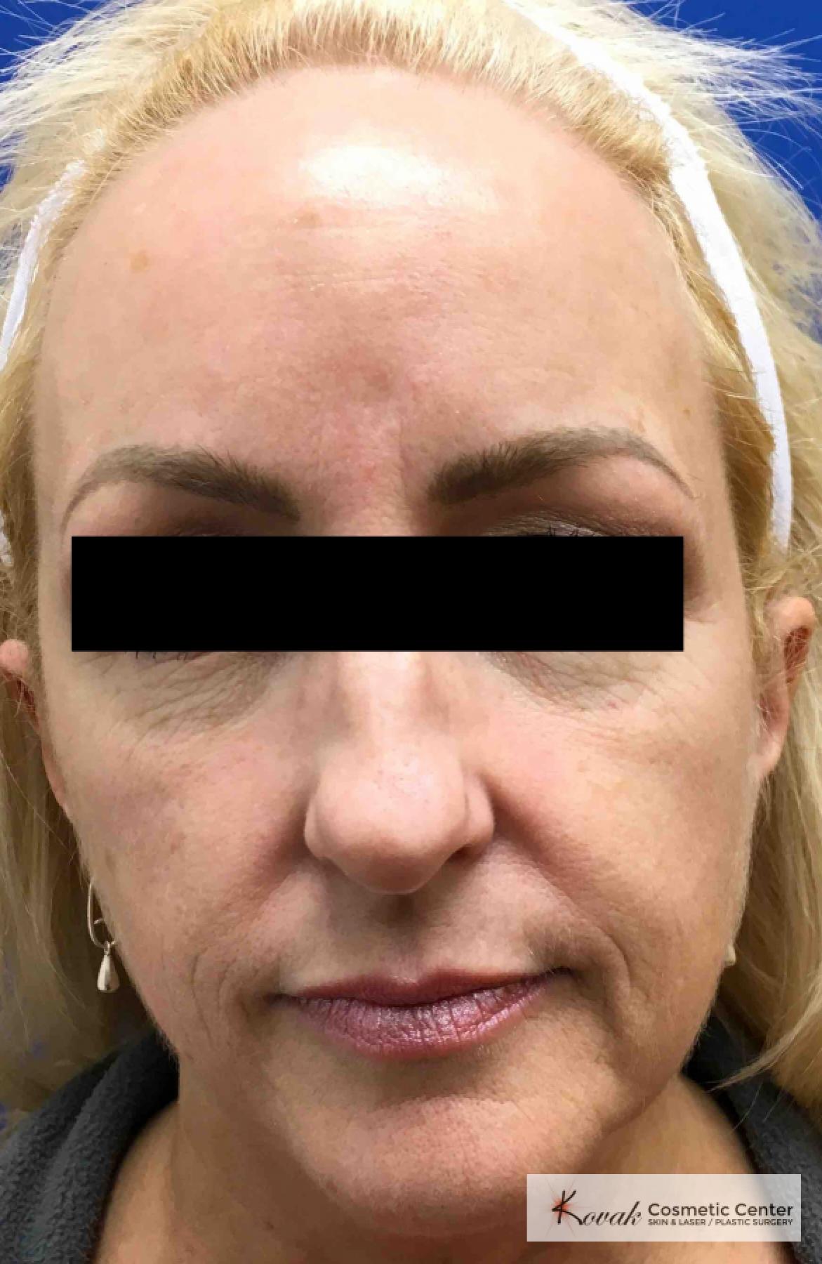 Injectables - Face: Patient 6 - Before 