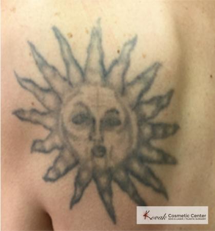 Tattoo Removal: Patient 3 - Before 1