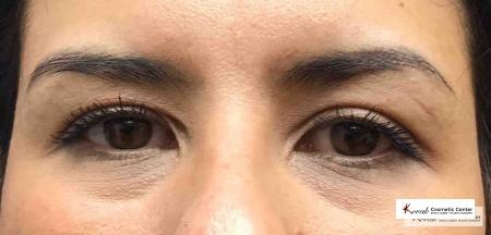 Restylane® Silk: Patient 1 - Before 