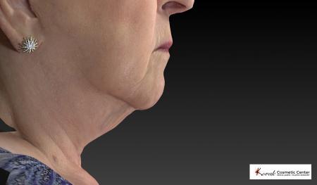CoolSculpting®: Patient 5 - Before 2