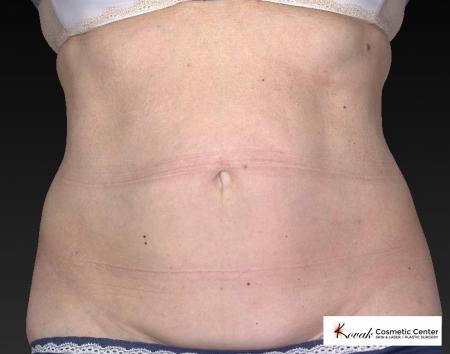 CoolSculpting®: Patient 12 - After