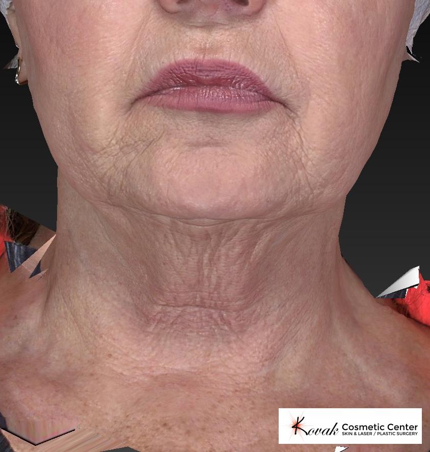 Kybella: Patient 2 - Before 