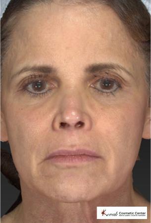 Silhouette Lift™: Patient 1 - After Image 2