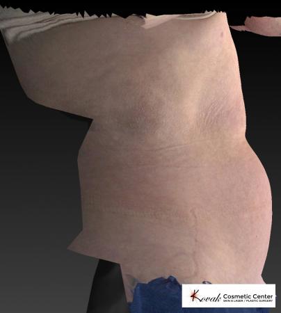 CoolSculpting®: Patient 13 - Before 4