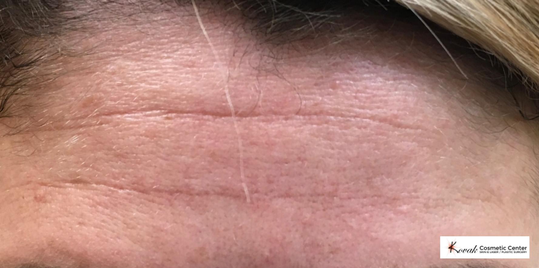 Restylane Silk for Forehead Lines on a 40 year old woman - After  