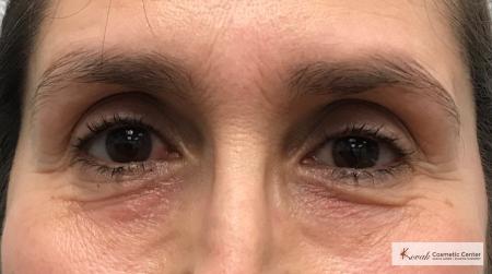 Restylane® Silk: Patient 11 - After 1