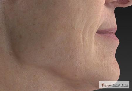 Injectables - Mouth: Patient 8 - After Image 2