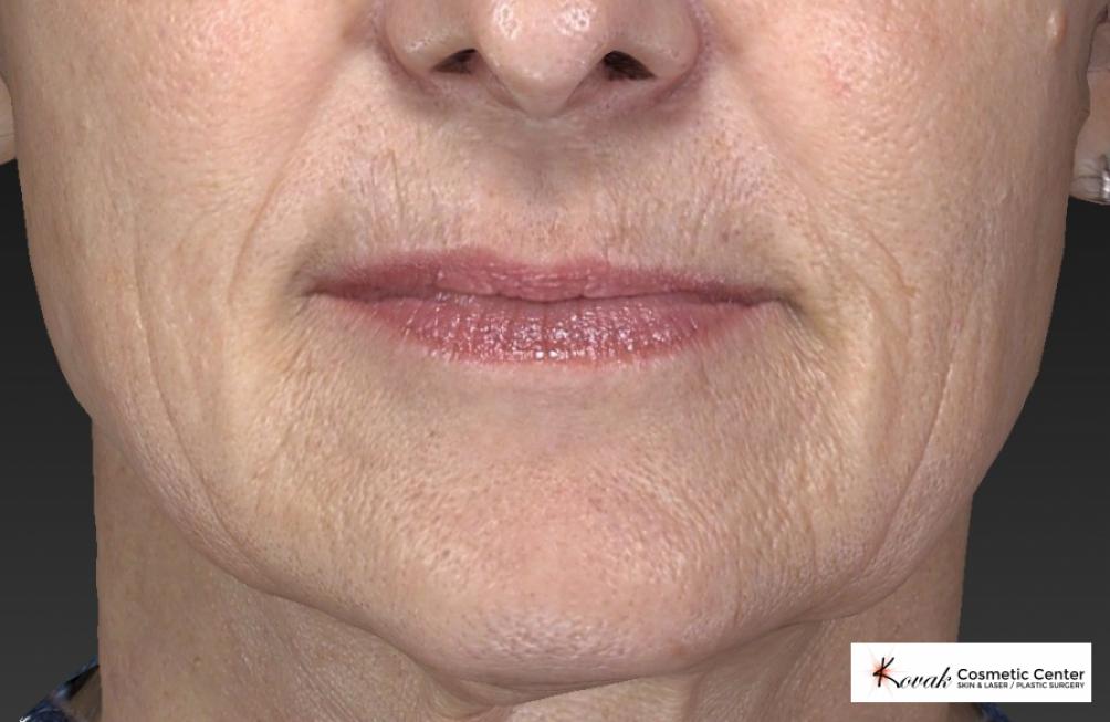 Restylane® Silk: Patient 2 - Before 