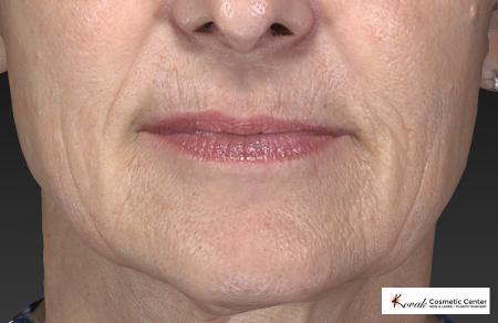 Restylane® Silk: Patient 2 - Before Image 1