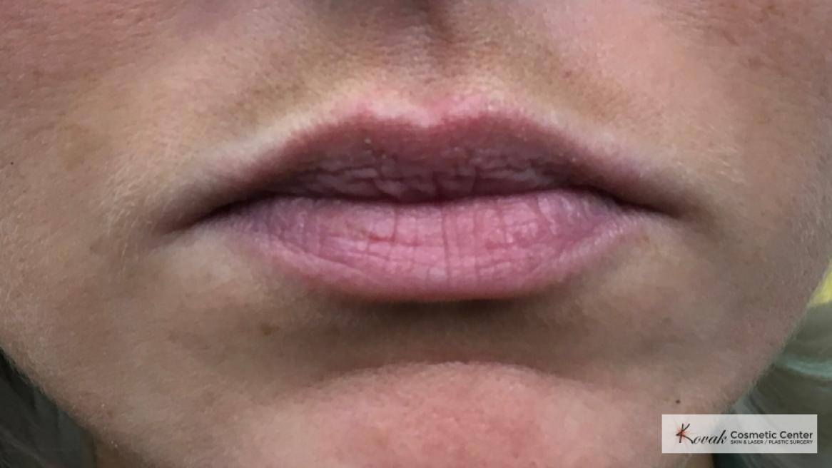 Lip Augmentation: Patient 3 - Before 