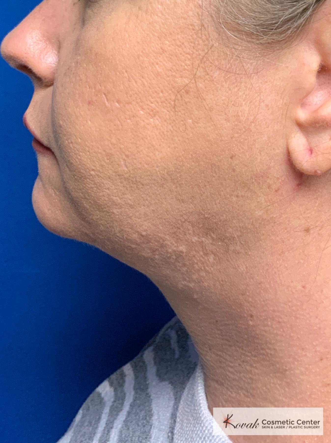 Laser Liposuction of the neck of a 44 year old female - After  