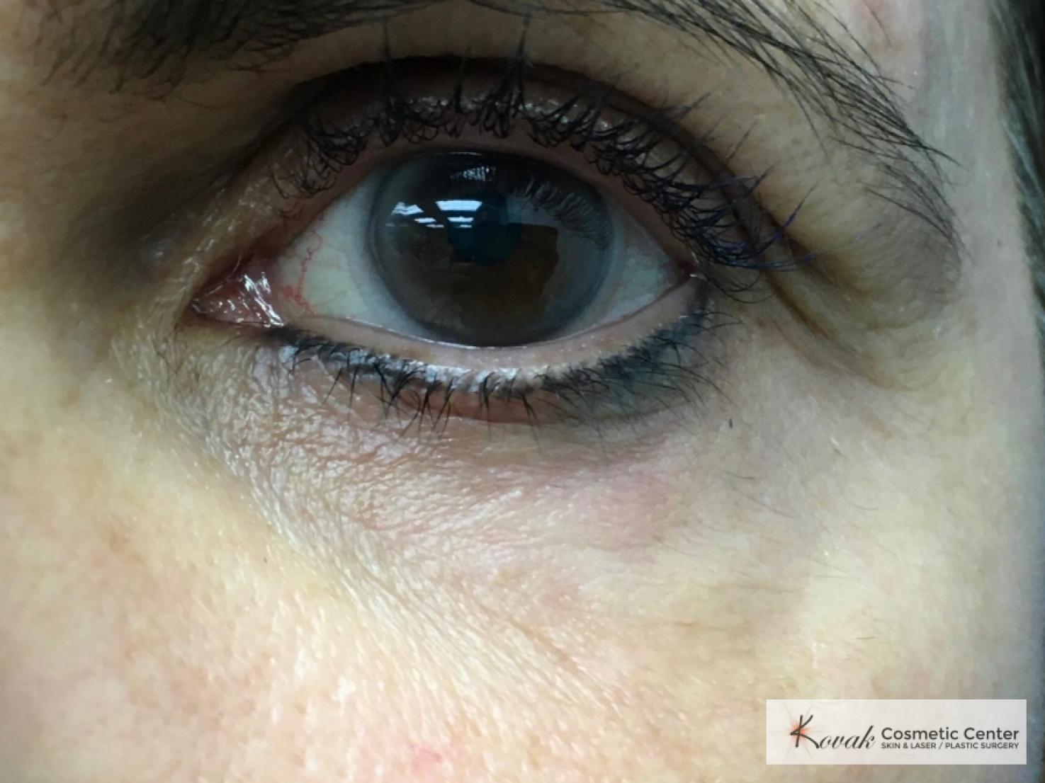 Under Eye Wrinkle Treatment with Agnes - After 2