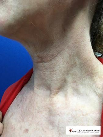 Microneedling on the neck of a 61 year old female using Scarlet - Before and After 2