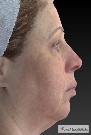 Tyte And Bryte – Face: Patient 3 - Before Image 1