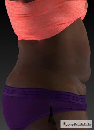CoolSculpting®: Patient 23 - After