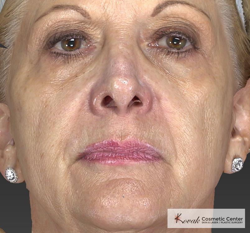 Injectables - Face: Patient 1 - Before 