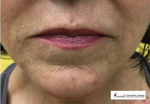 Restylane® Silk: Patient 4 - After  