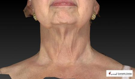 Kybella: Patient 3 - After Image 3