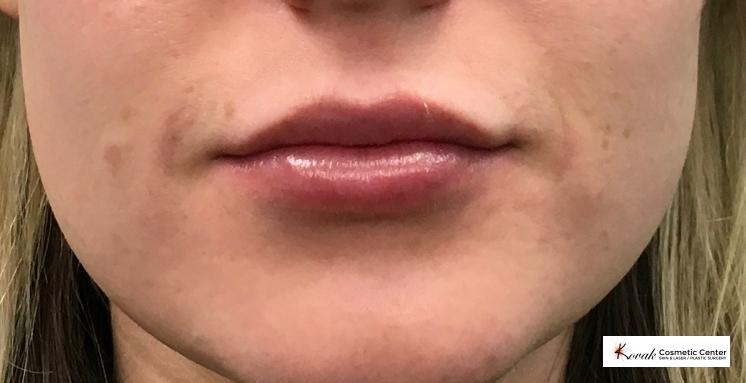 Juvéderm® XC: Patient 5 - After  
