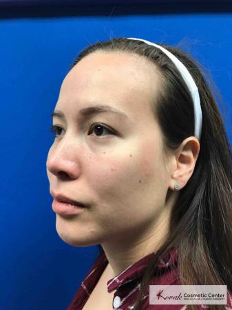 Restylane® Lyft: Patient 2 - After 2