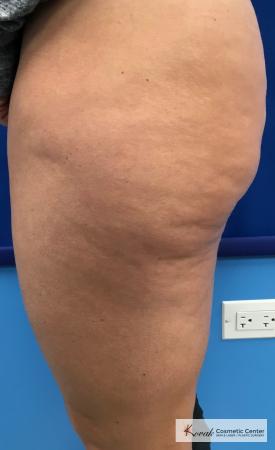 Cellulite Reduction: Patient 4 - Before 2