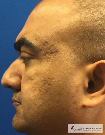 Juvéderm® XC: Patient 7 - Before and After 3