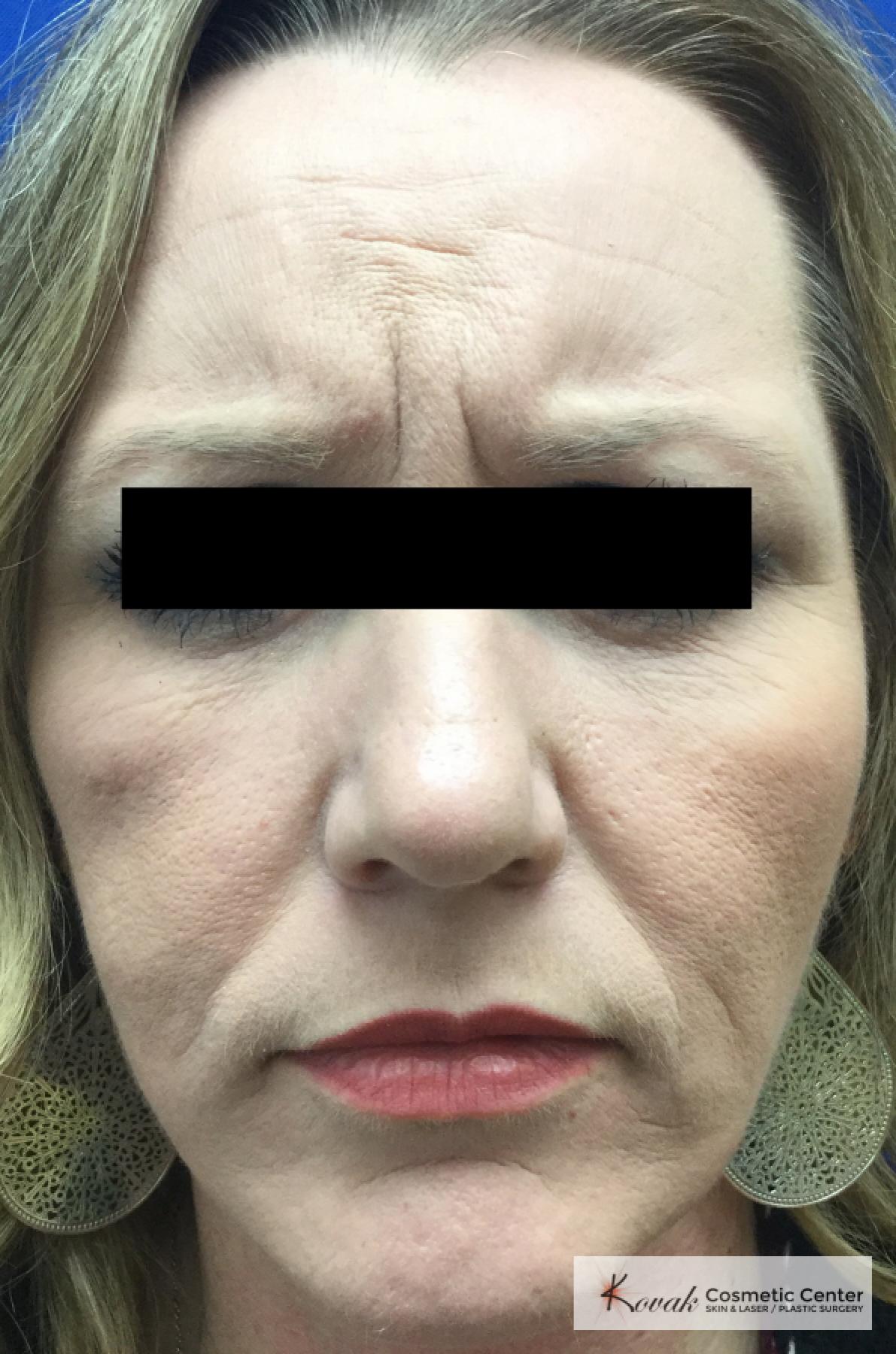 BOTOX® Cosmetic: Patient 6 - Before and After 2