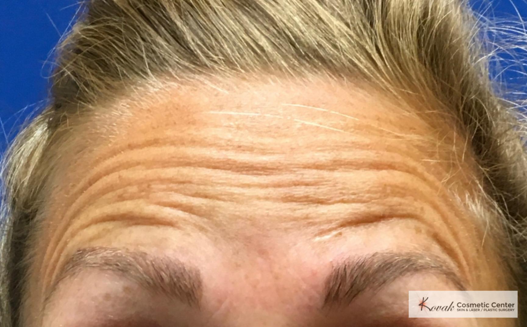 BOTOX® Cosmetic: Patient 7 - Before 