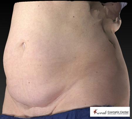 CoolSculpting®: Patient 12 - Before 3