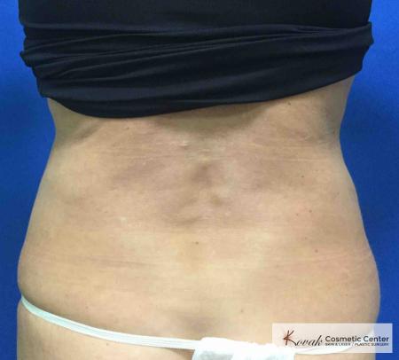 EMSCULPT®: Patient 2 - Before and After 4