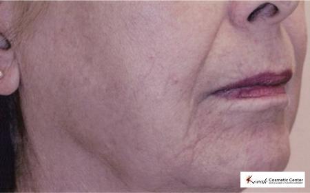 Tyte & Bryte Photorejuvenation on the face of a 57 year old female - After 1