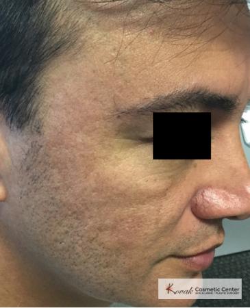 Juvéderm® XC: Patient 9 - After 2