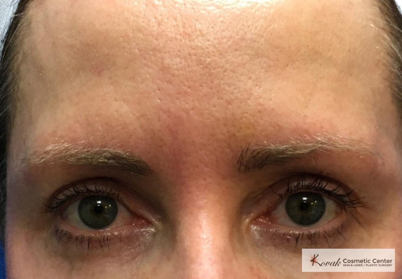 Upper eyelid treatment using Agnes on a 49 year old woman - Before 1