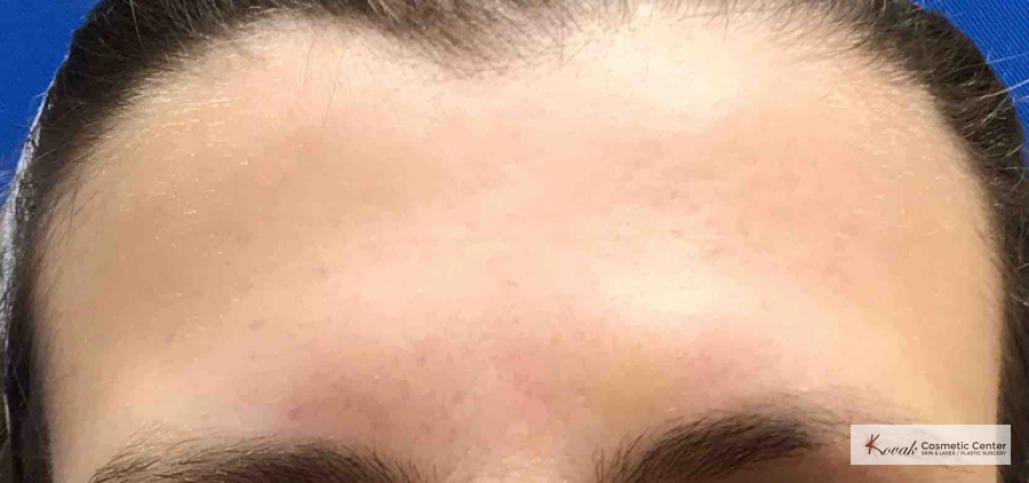 Restylane®: Patient 5 - After  