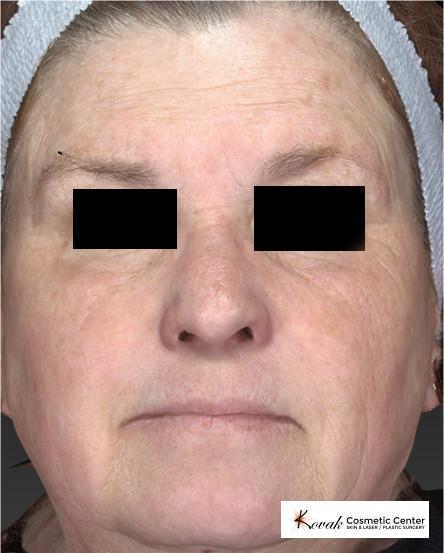 Halo™: Patient 1 - After  