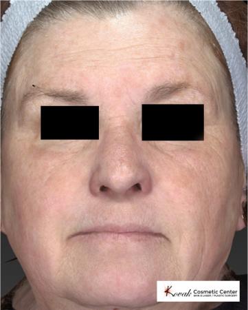Halo™: Patient 1 - After 1